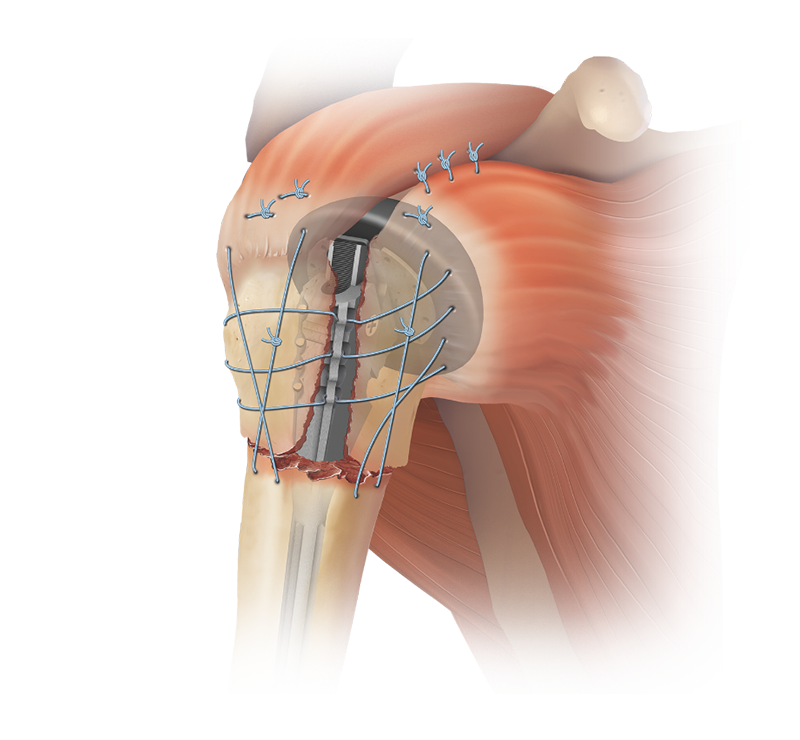 Arthrex - Total Shoulder Arthroplasty